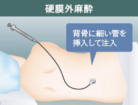 硬膜外麻酔とは