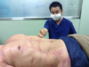 お腹と胸の脂肪吸引翌日の男性モニター