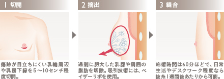 真性女性化乳房の治療