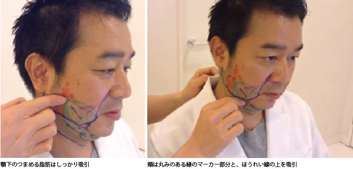 顔（頬・顎）の脂肪吸引のポイント