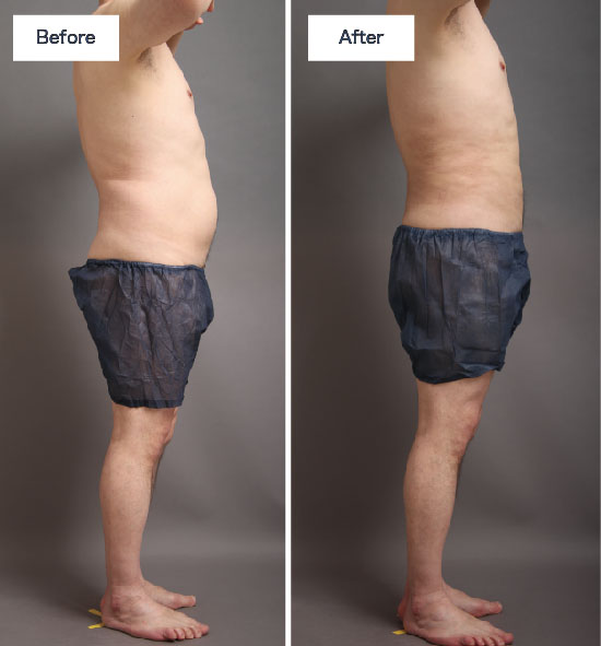 お腹、腰の脂肪吸引:手術前後の比較(男性)