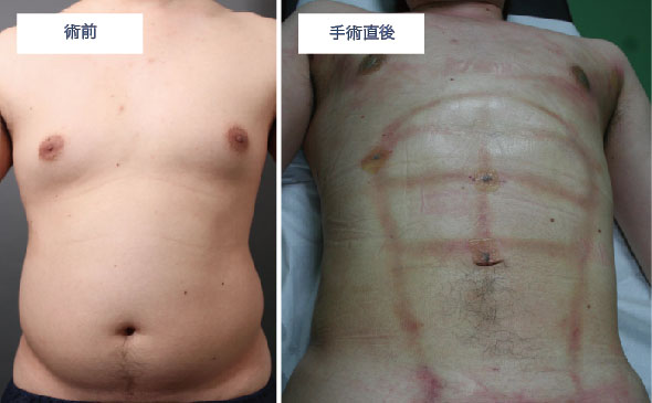 脂肪吸引直後の胸とお腹の状態