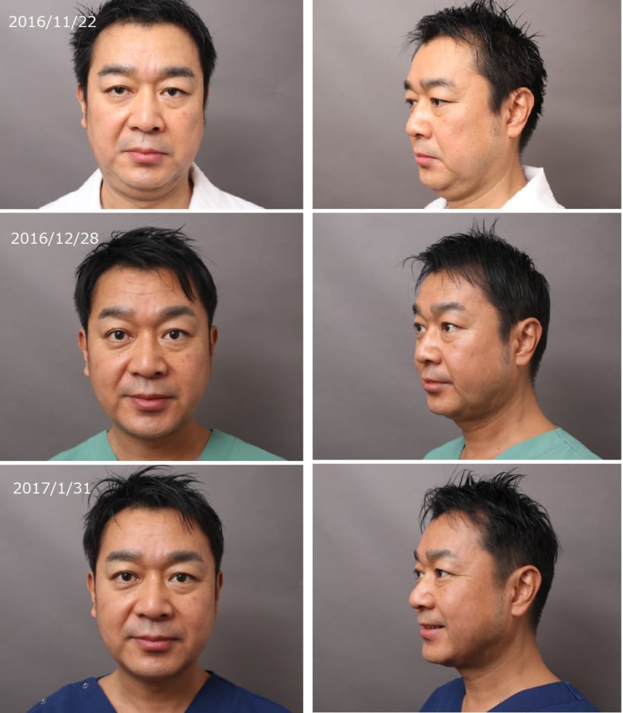 顔（頬・顎）の脂肪吸引を行った男性モニター