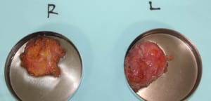 女性化乳房のゲストの胸から取り出した乳腺