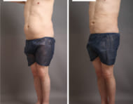 お腹・腰の脂肪吸引の効果と、男性にも気を付けて欲しい術後ケア