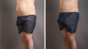 お腹・腰の脂肪吸引の効果と、男性にも気を付けて欲しい術後ケア