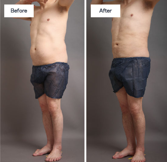 お腹、腰の脂肪吸引:手術前後の比較(男性)