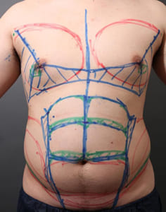 お腹と胸部の脂肪吸引前のデザイン