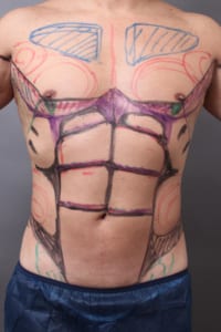 お腹・胸の仕上がりを決める脂肪吸引前のデザイン