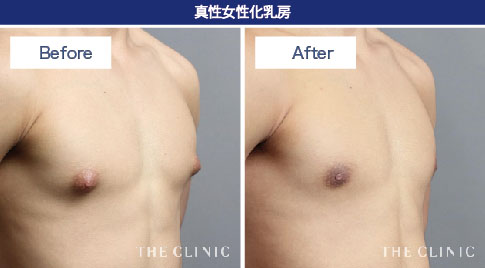 真性女性化乳房の症例写真