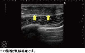 女性化乳房の治療前に行うエコー検査
