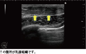 真性女性化乳房治療の実際を、医師目線で完全レポート