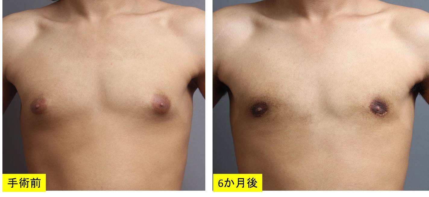 女性化乳房の治療前後を比較:前