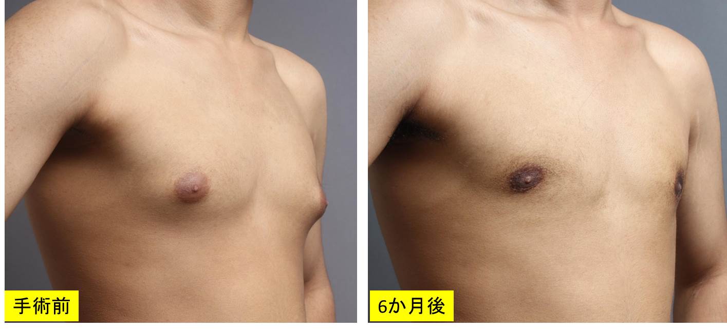 女性化乳房の治療前後を比較:横