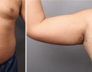 脂肪吸引を受けられた男性の術後1年の写真を公開
