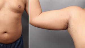 脂肪吸引を受けられた男性の術後1年の写真を公開