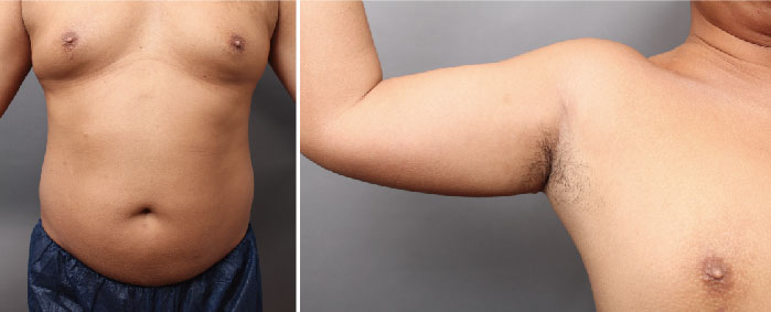 脂肪吸引を受けられた男性の術後1年の写真を公開