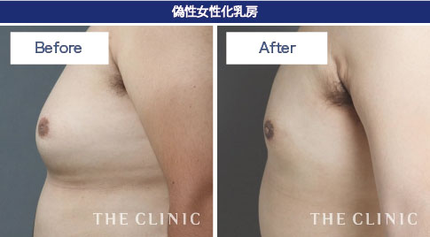 偽性女性化乳房の症例写真
