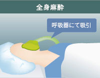 全身麻酔とは