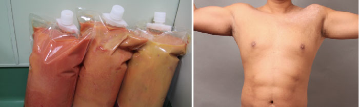 お腹、胸、二の腕の脂肪吸引の術後