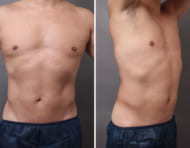 男性必見! 鍛えたかのような腹筋・胸筋が手に入る脂肪吸引とは？