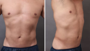 男性必見! 鍛えたかのような腹筋・胸筋が手に入る脂肪吸引とは？