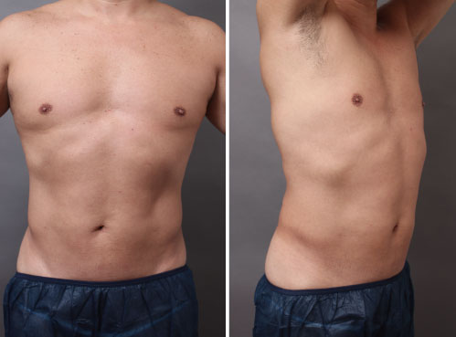 男性必見! 鍛えたかのような腹筋・胸筋が手に入る脂肪吸引とは？