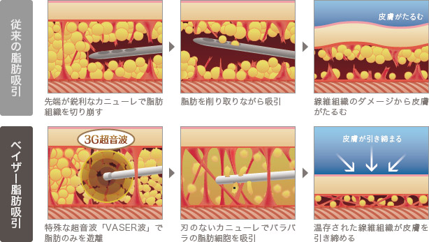 ベイザー脂肪吸引と従来の脂肪吸引の比較図