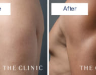 男性らしい二の腕をつくりあげる最高峰の脂肪吸引とは?