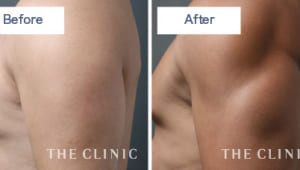 男性らしい二の腕をつくりあげる最高峰の脂肪吸引とは?