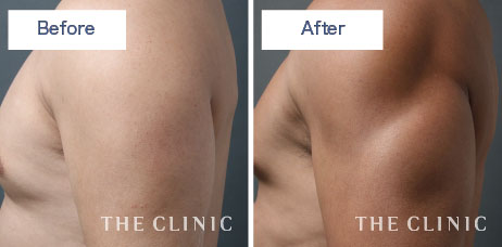 男性らしい二の腕をつくりあげる最高峰の脂肪吸引とは?