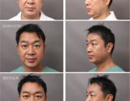 男性の顔（頬・顎）脂肪吸引 ～見た目の若返りを目指せ! ～