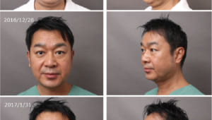 男性の顔（頬・顎）脂肪吸引 ～見た目の若返りを目指せ! ～