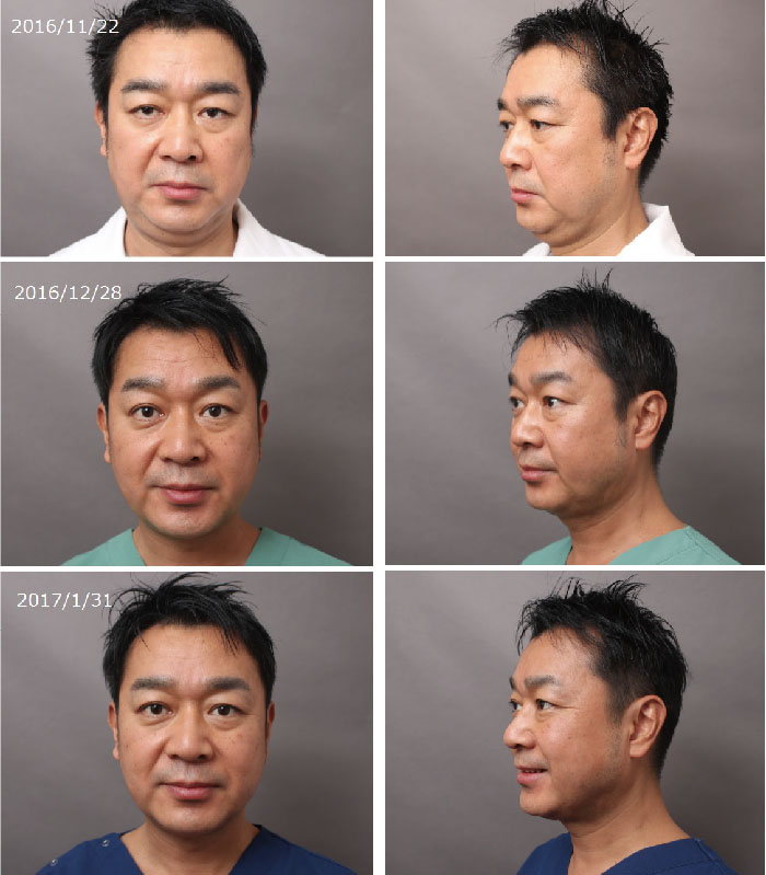 男性の顔（頬・顎）脂肪吸引 ～見た目の若返りを目指せ! ～