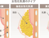 女性化乳房の治療法とよくある質問