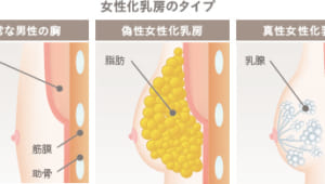 女性化乳房の治療法とよくある質問