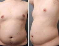 お腹と胸部の脂肪吸引：最上級の男性向け施術4Dスカルプトの威力とは?