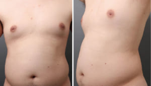 お腹と胸部の脂肪吸引：最上級の男性向け施術4Dスカルプトの威力とは?