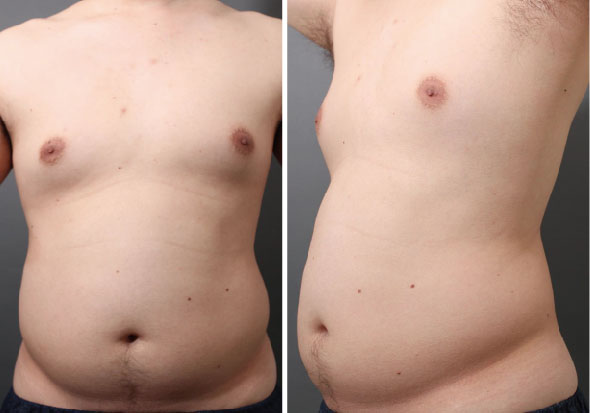 お腹と胸部の脂肪吸引：最上級の男性向け施術4Dスカルプトの威力とは?