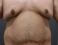 脂肪吸引とたるみ改善で、胸部の引き締めMAX