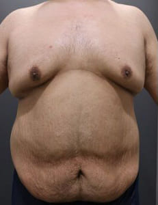 肥満ゲストの脂肪吸引