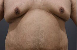 脂肪吸引とたるみ改善で、胸部の引き締めMAX