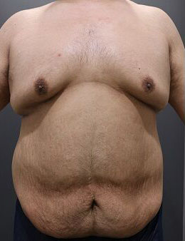 脂肪吸引とたるみ改善で、胸部の引き締めMAX