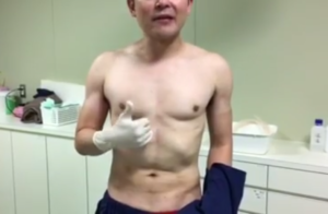 ベイザー脂肪吸引で作り上げた腹筋の陰影