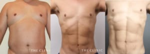 男性の脂肪吸引症例（お腹）