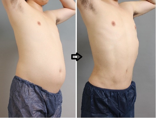 お腹の脂肪吸引の症例写真(男性/斜め)