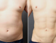 男性専用脂肪吸引 ベイザー4Dスカルプトとは?