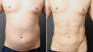 男性専用脂肪吸引 ベイザー4Dスカルプトとは?