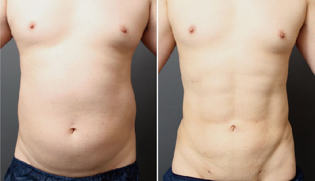 男性専用脂肪吸引 ベイザー4Dスカルプトとは?