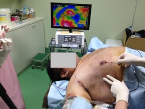 サーミタイトの術中写真